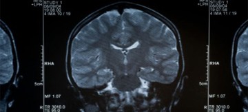 MRI-brain-scan_jpg-770-x350